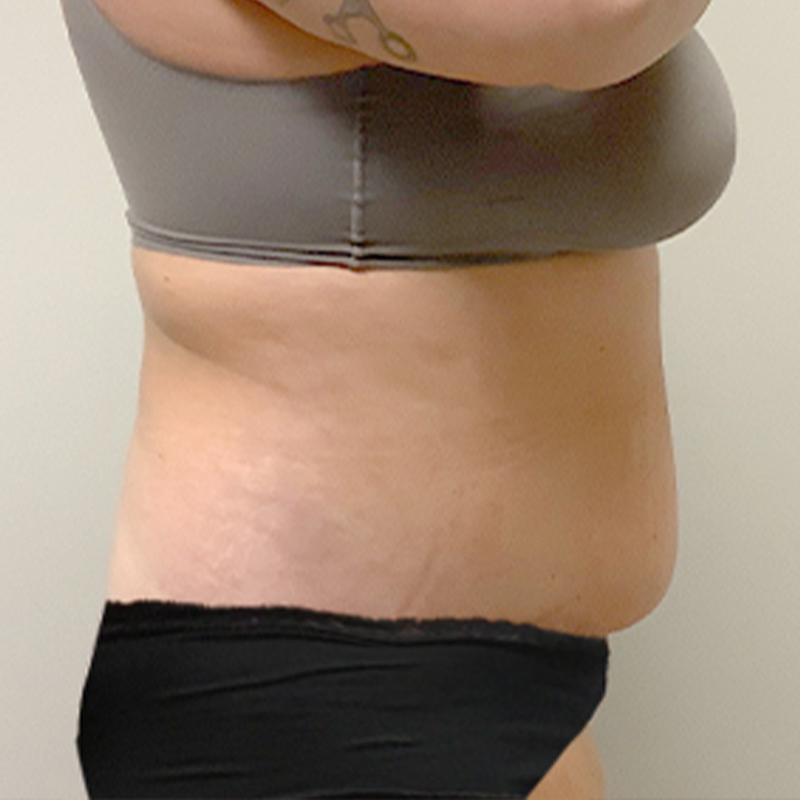 Abdominoplasty 09