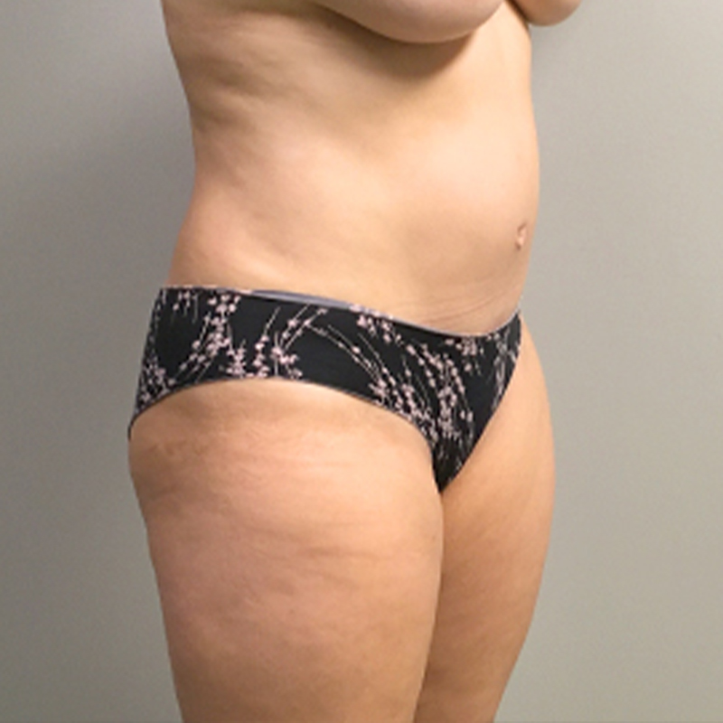 Abdominoplasty 07
