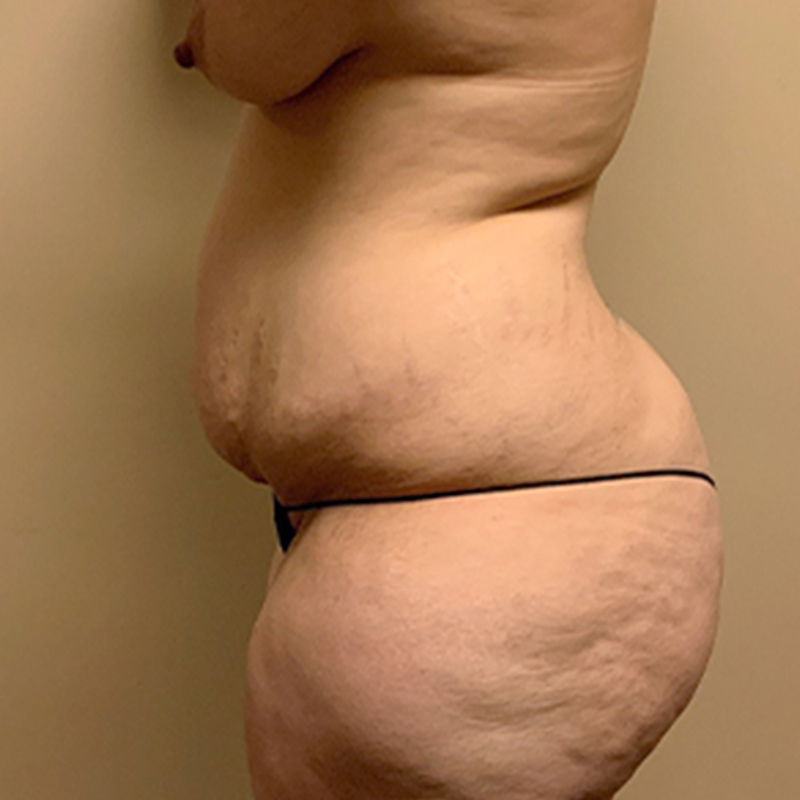 Abdominoplasty 05