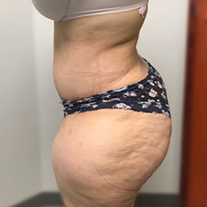 Abdominoplasty 05