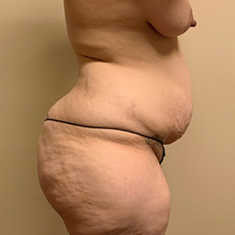 Abdominoplasty 09