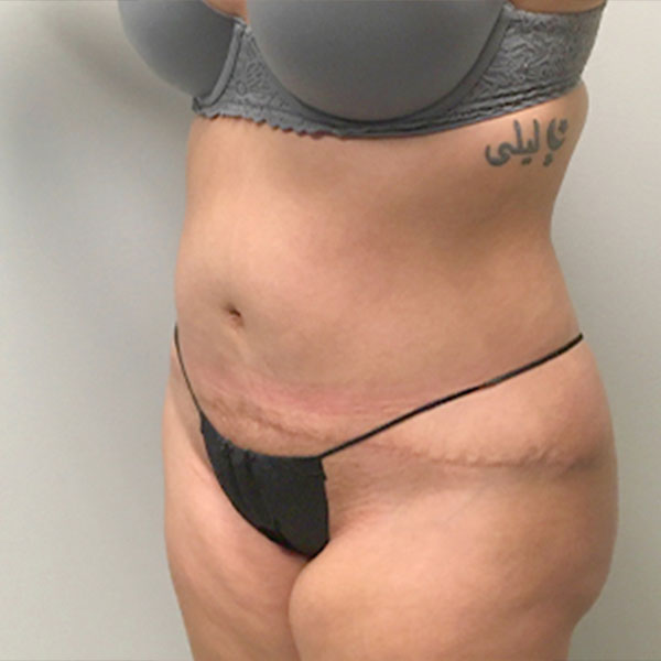 Abdominoplasty 03