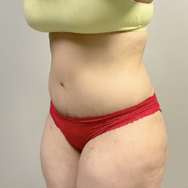 Abdominoplasty 03