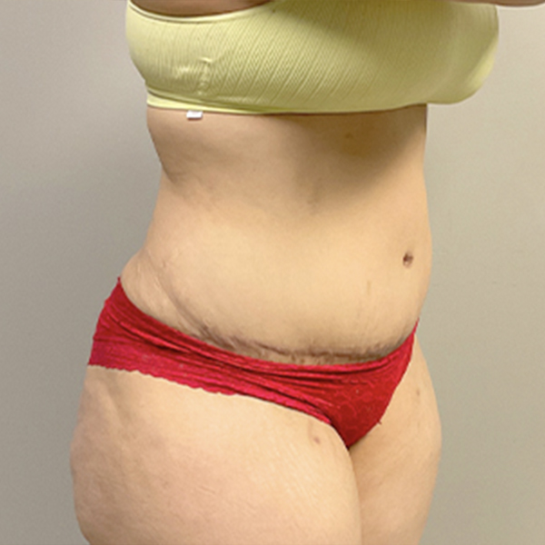Abdominoplasty 07