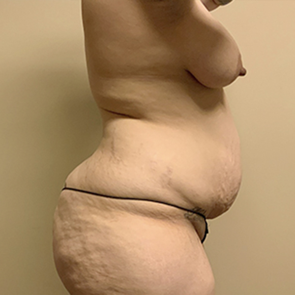 Abdominoplasty 09