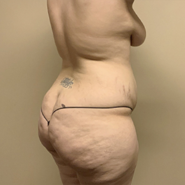 Abdominoplasty 11