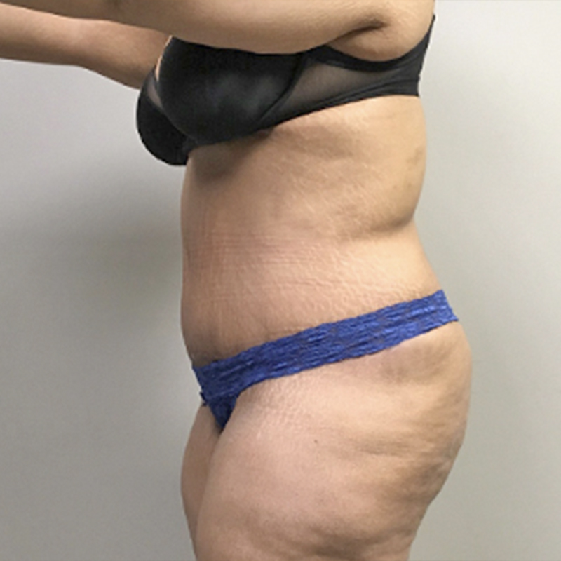 Abdominoplasty 05