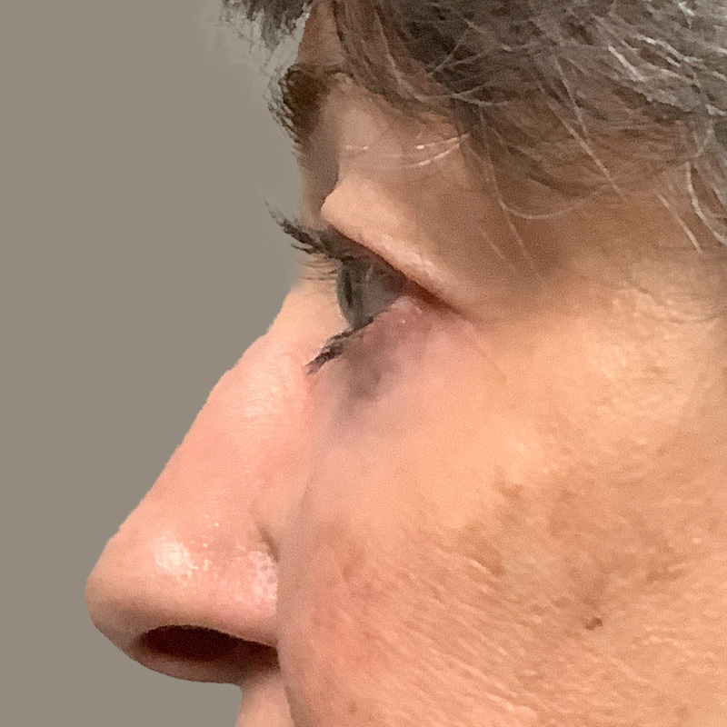 Blepharoplasty 05