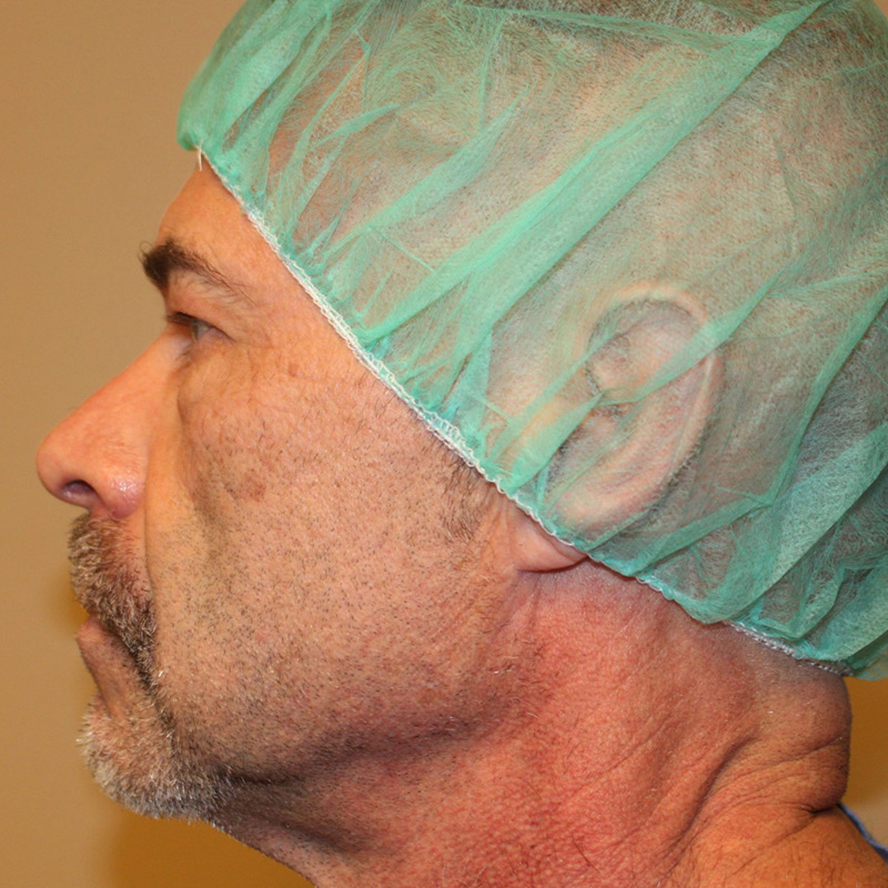 Blepharoplasty 03