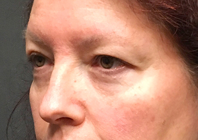 Blepharoplasty 03