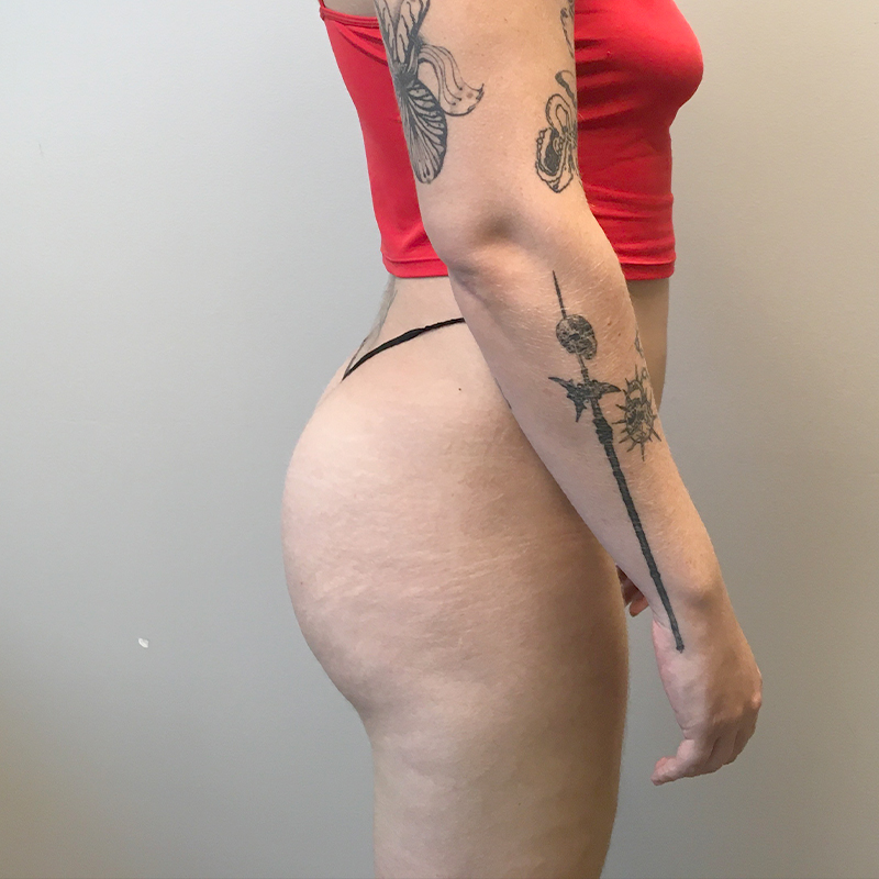 Brazilian Butt Lift 03