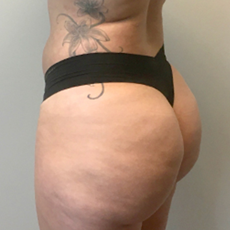 Brazilian Butt Lift 03