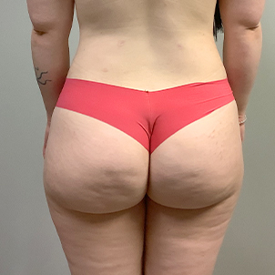 Brazilian Butt Lift 03