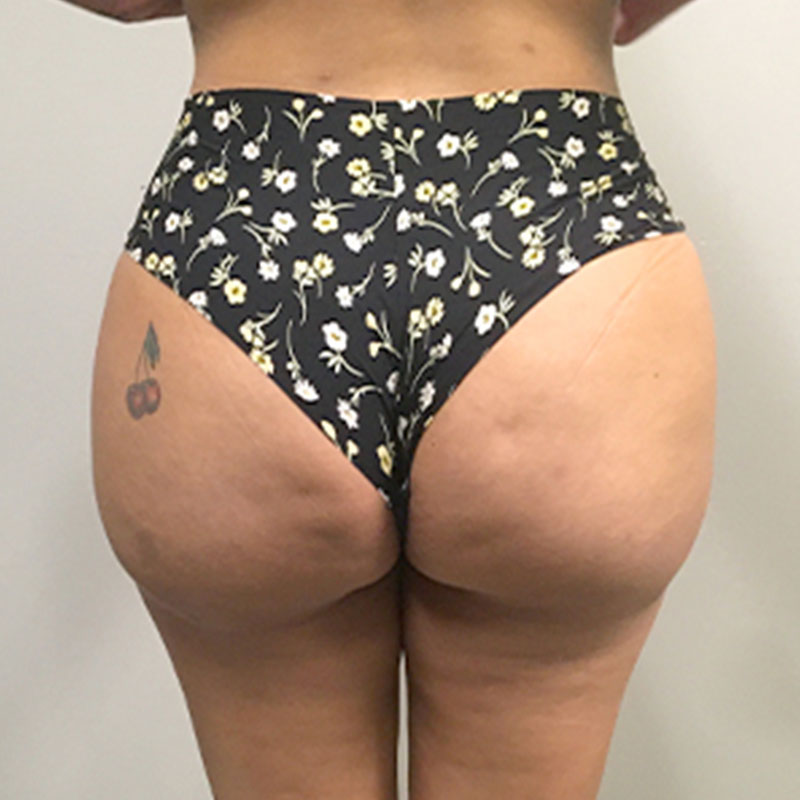 Brazilian Butt Lift 04