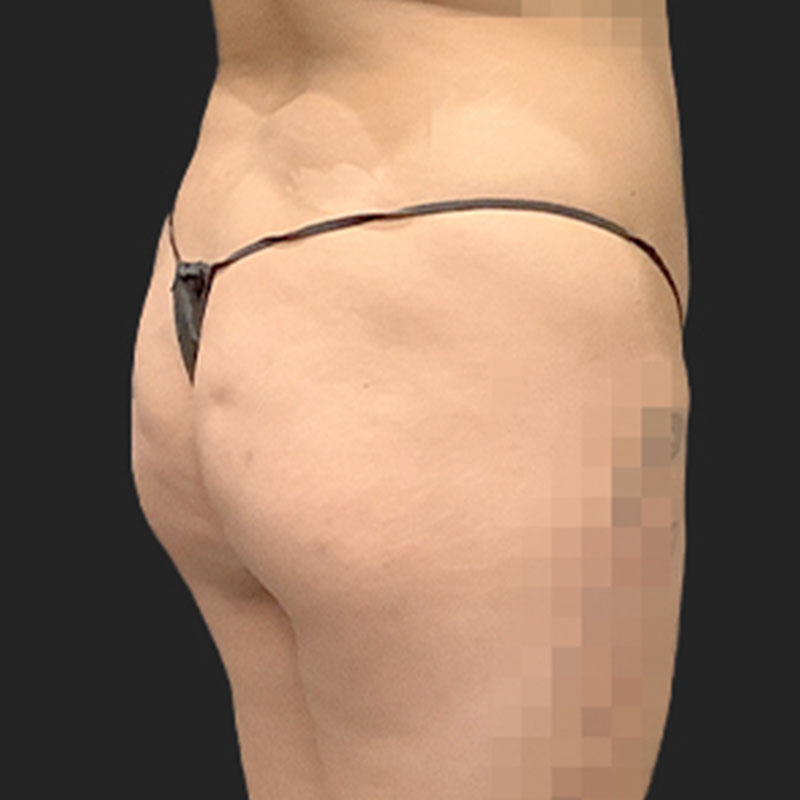 Brazilian Butt Lift 05