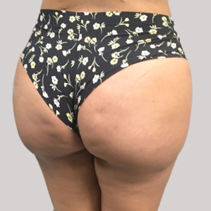 Brazilian Butt Lift 05