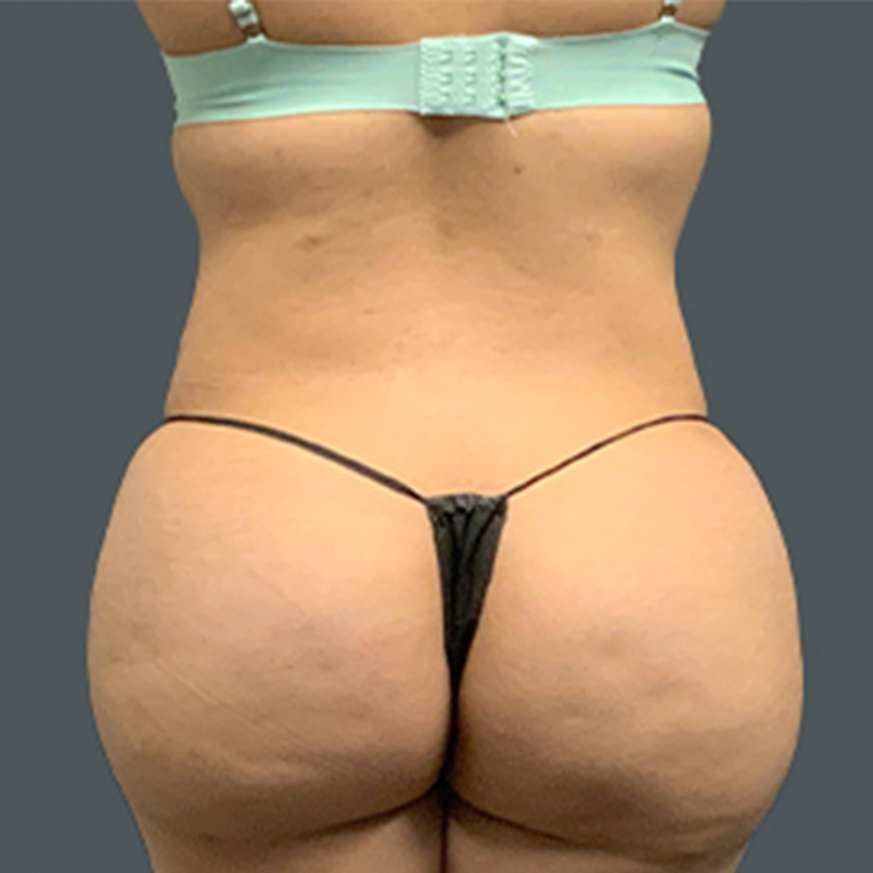 Brazilian Butt Lift 05