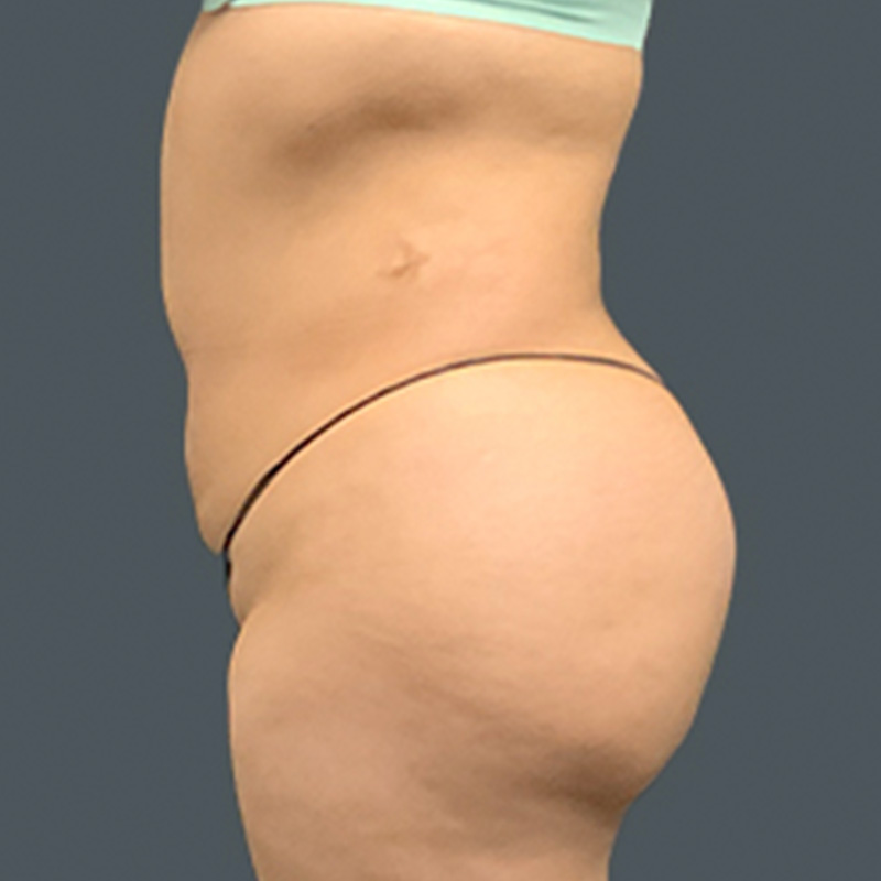 Brazilian Butt Lift 05