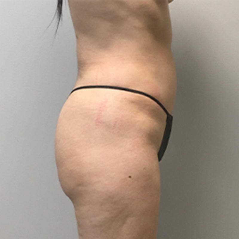 Brazilian Butt Lift 03