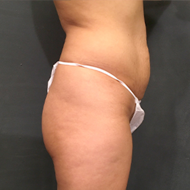 Brazilian Butt Lift 03