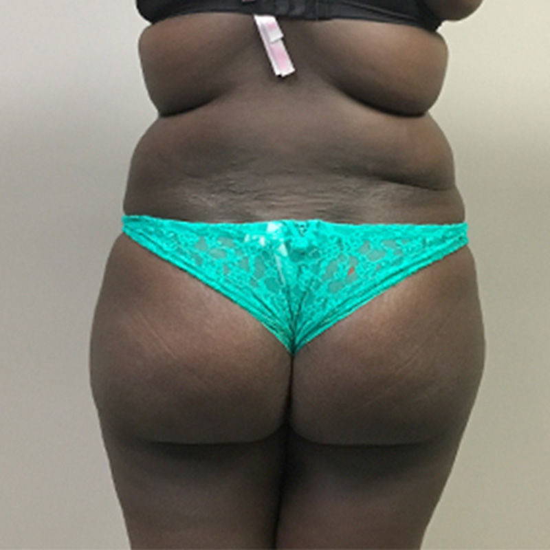 Brazilian Butt Lift 08