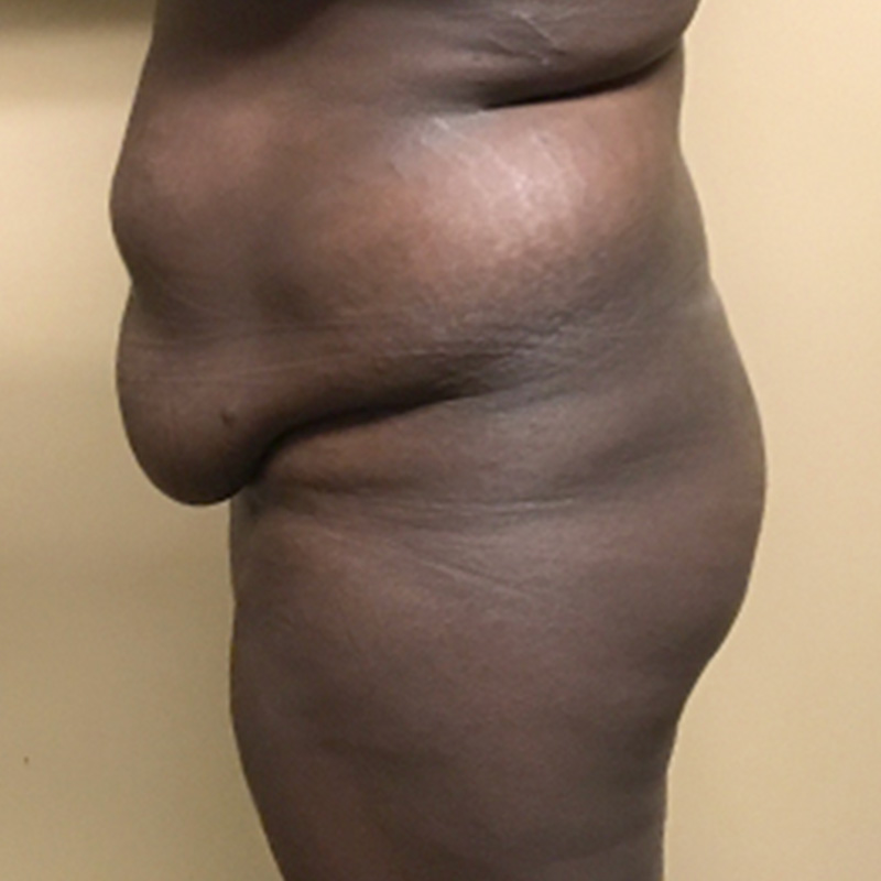 Brazilian Butt Lift 03