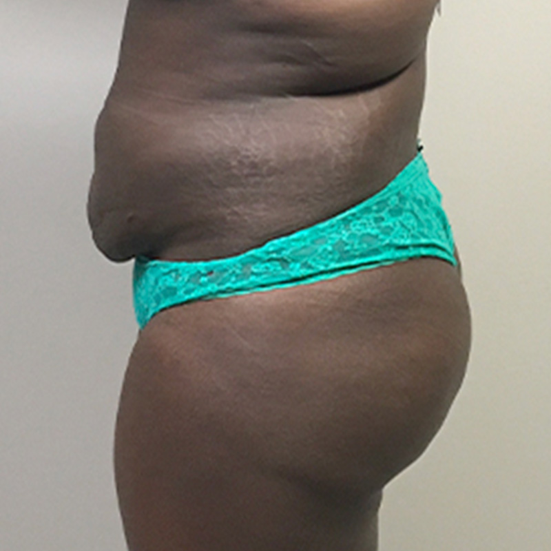 Brazilian Butt Lift 03