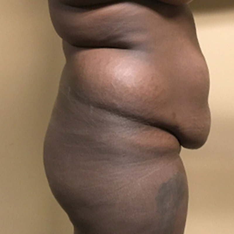 Brazilian Butt Lift 05