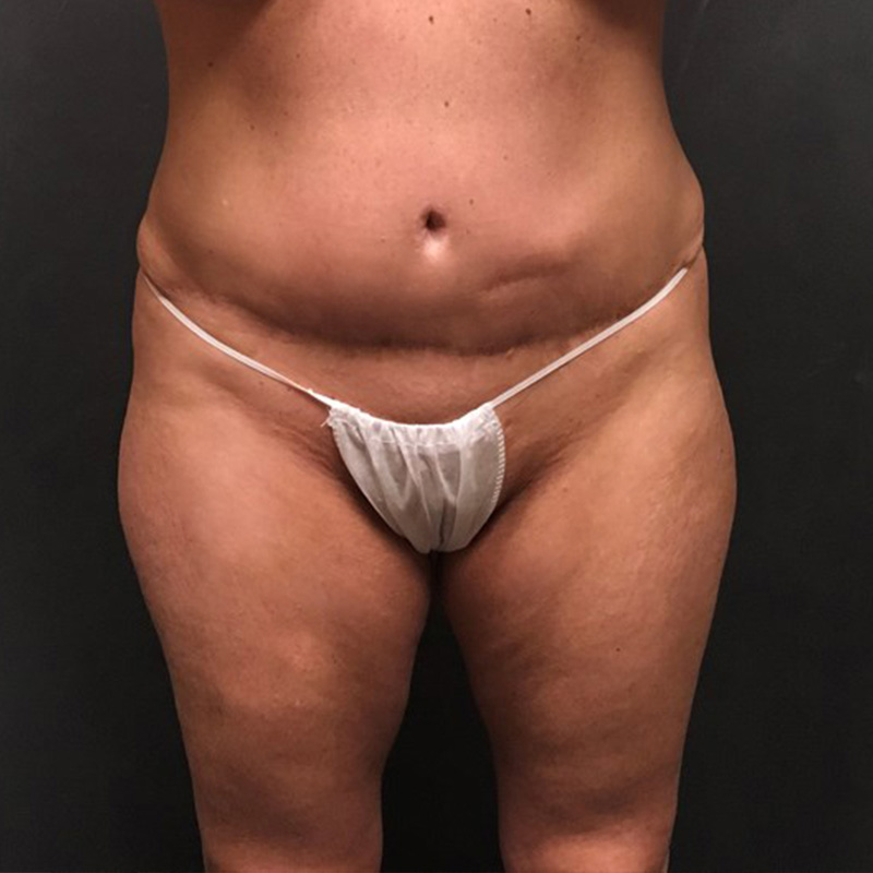 Brazilian Butt Lift 01