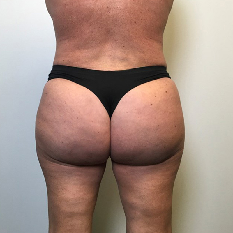 Brazilian Butt Lift 03