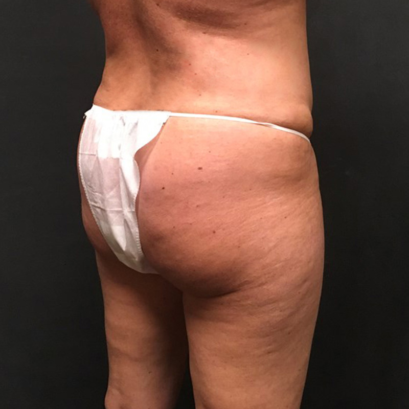 Brazilian Butt Lift 07