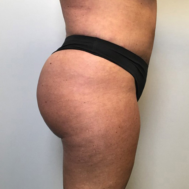 Brazilian Butt Lift 11