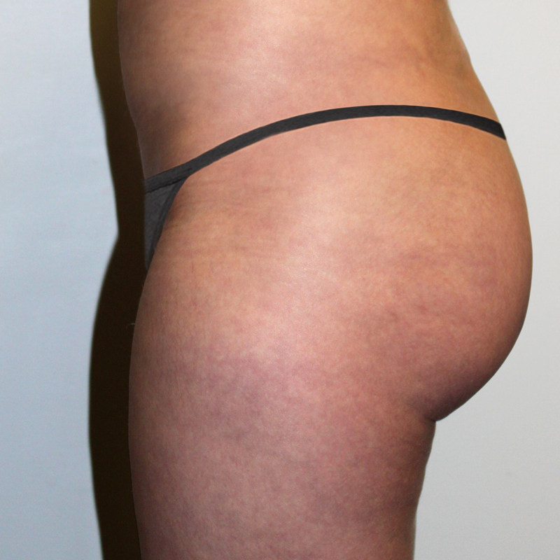 Brazilian Butt Lift 03