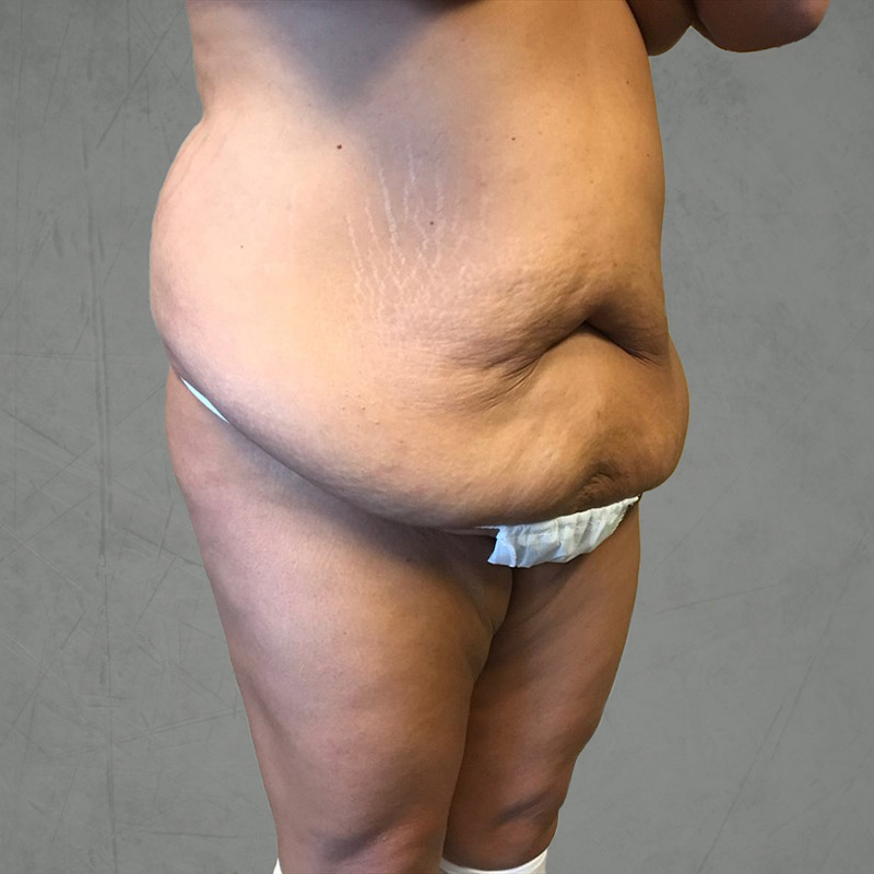 Brazilian Butt Lift 03