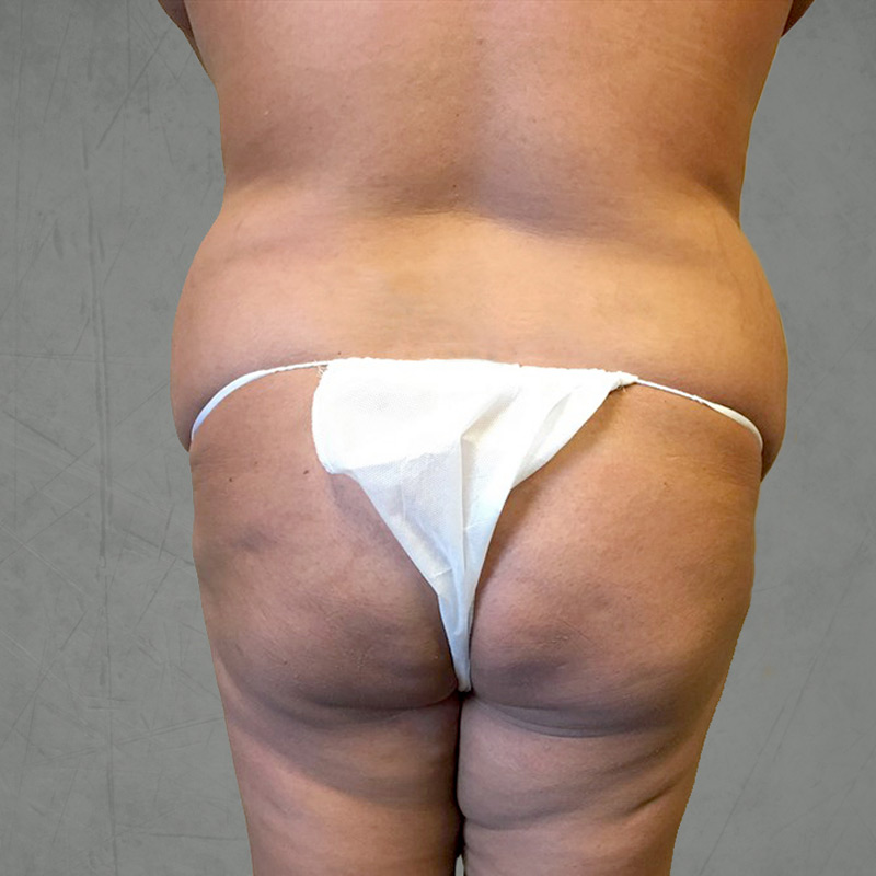 Brazilian Butt Lift 11