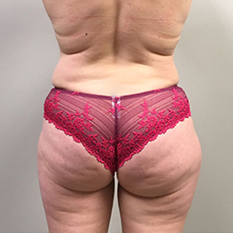 Brazilian Butt Lift 25