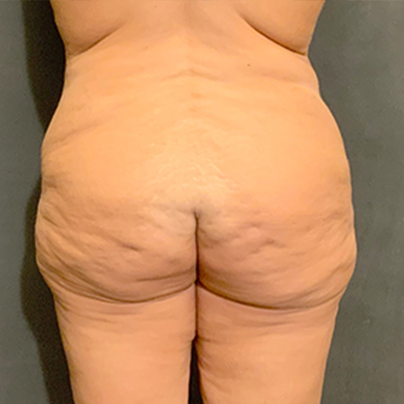 Brazilian Butt Lift 01