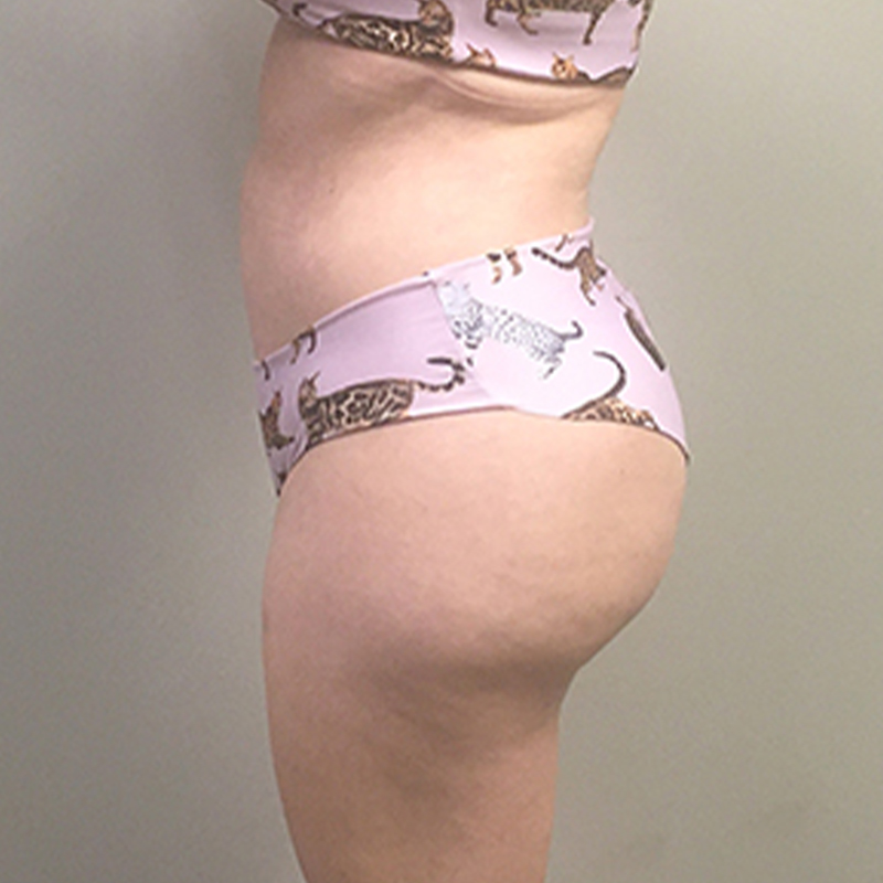 Brazilian Butt Lift 03