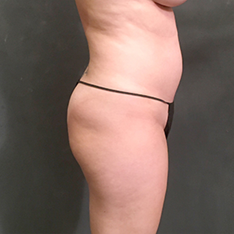 Brazilian Butt Lift 05