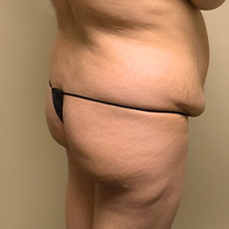 Brazilian Butt Lift 07