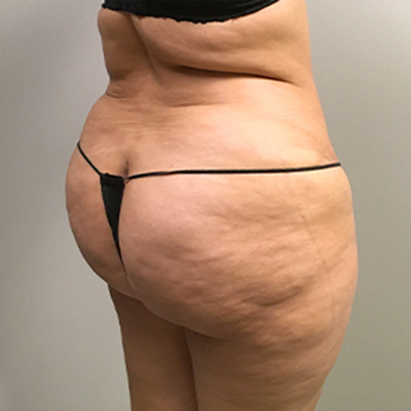 Brazilian Butt Lift 30