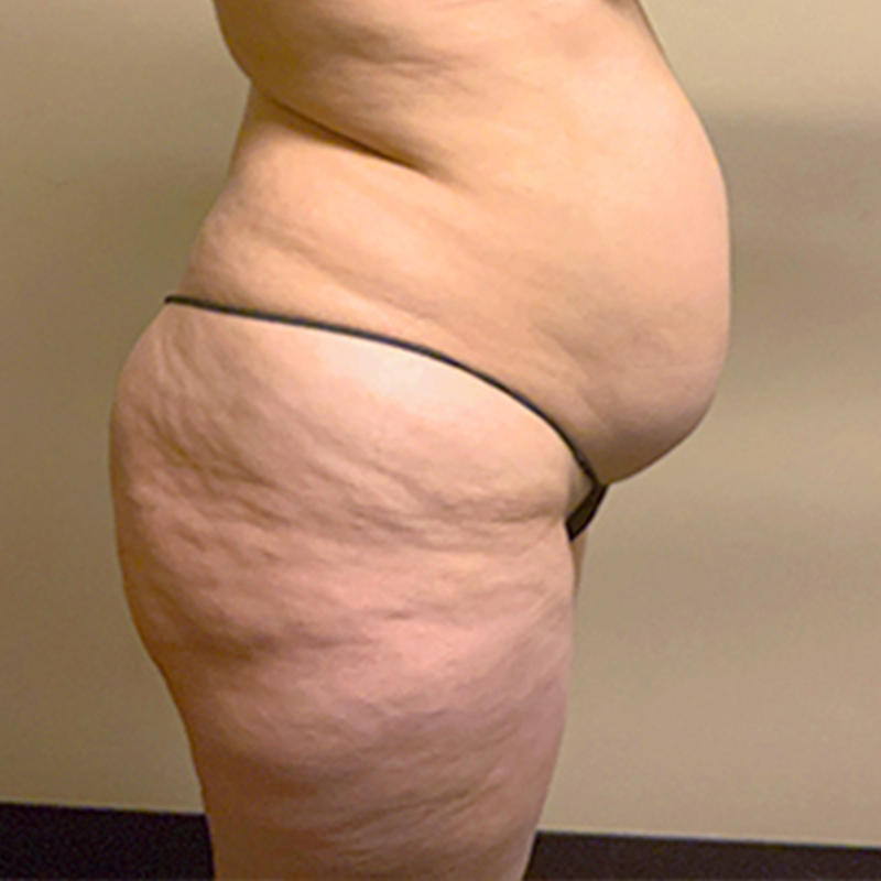 Brazilian Butt Lift 05