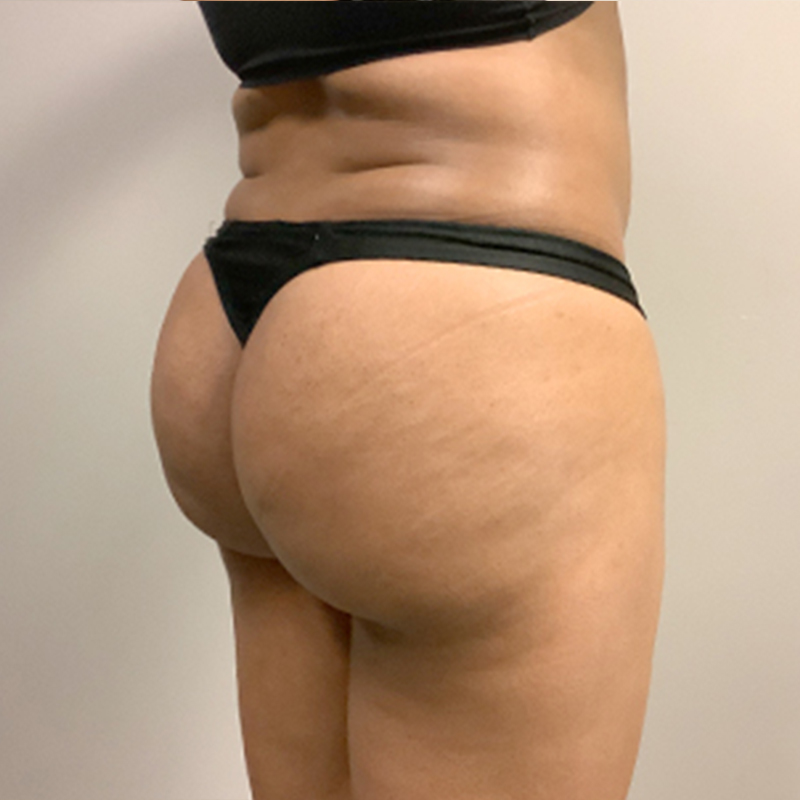 Brazilian Butt Lift 07