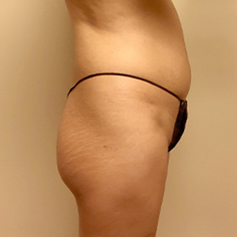 Brazilian Butt Lift 07