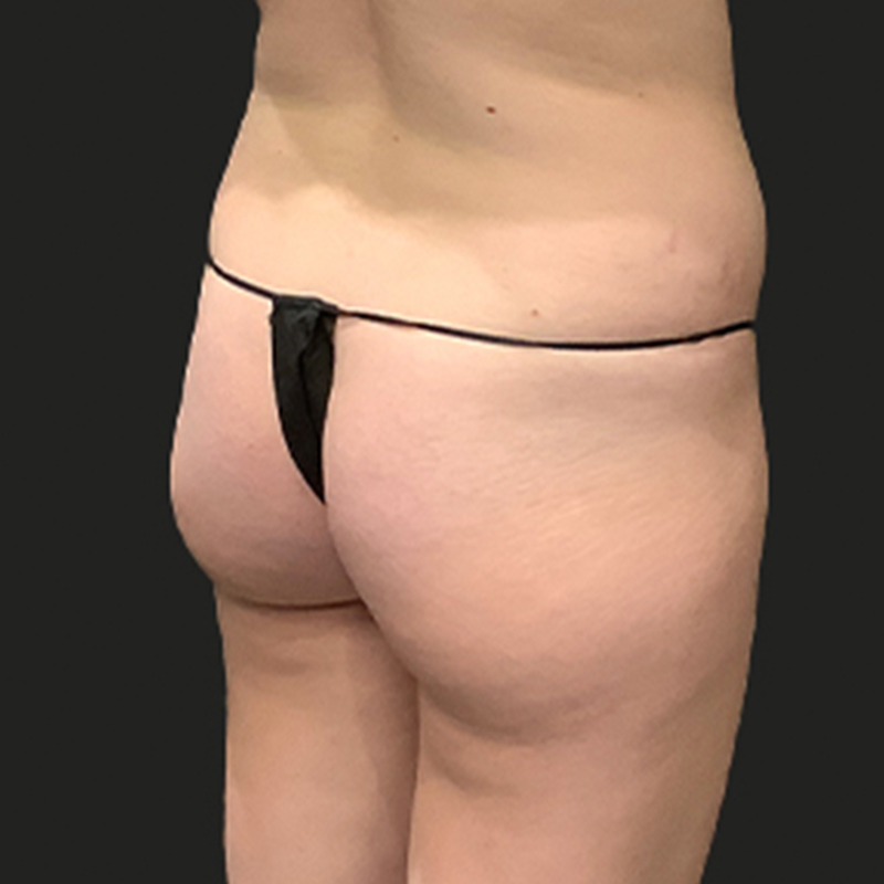 Brazilian Butt Lift 07