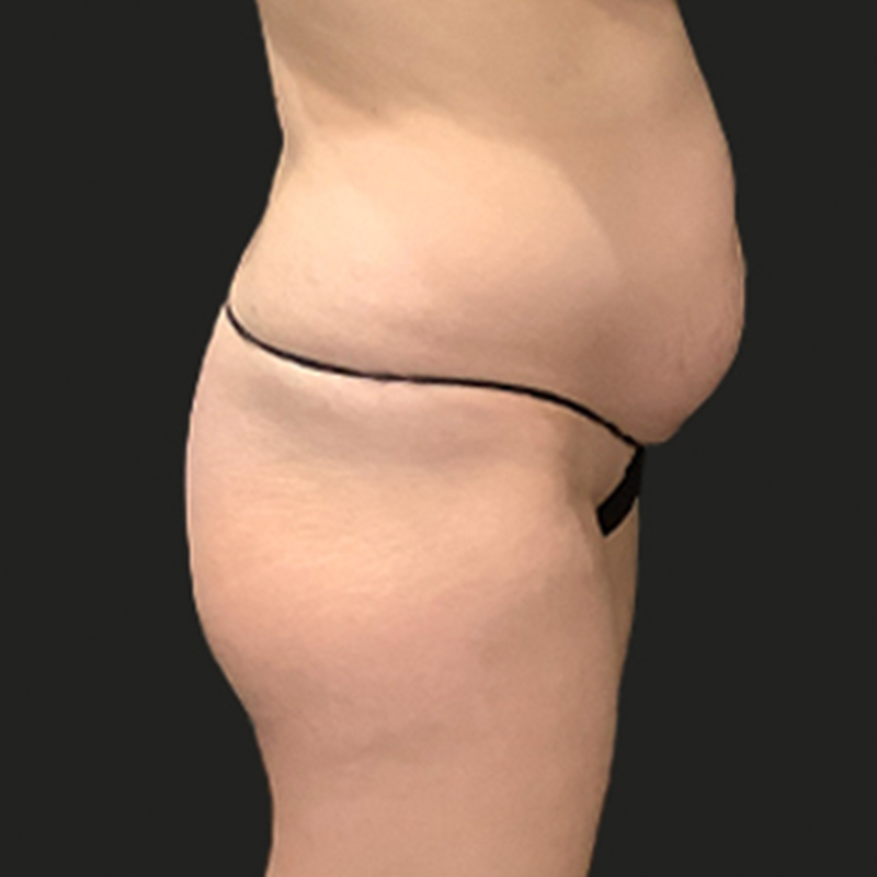 Brazilian Butt Lift 09