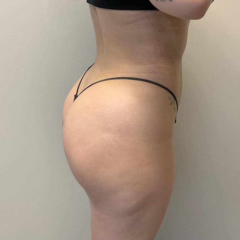 Brazilian Butt Lift 03