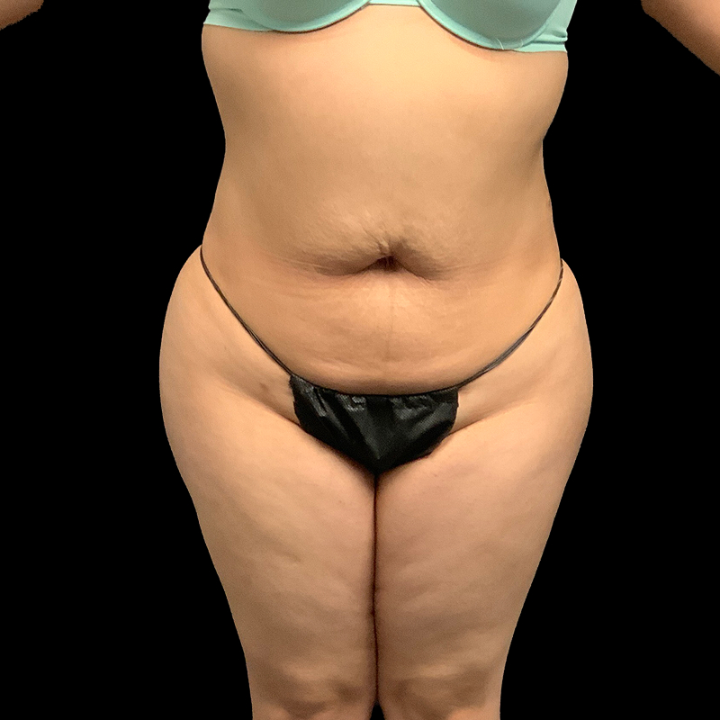 Brazilian Butt Lift 39