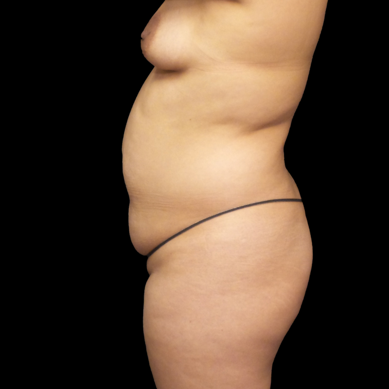 Brazilian Butt Lift 05