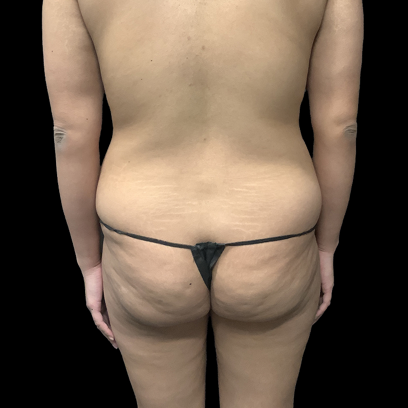 Brazilian Butt Lift 01